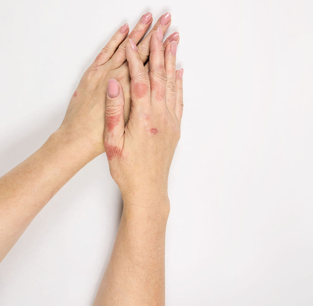 Women's hands on a white background showing red patches of irritated skin